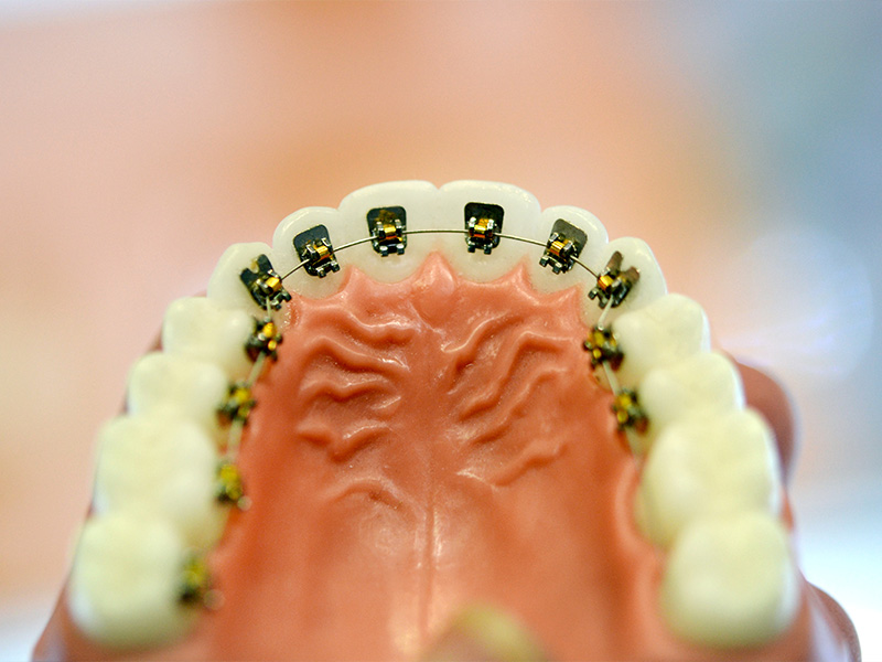 אילו שיטות קיימות ליישור שיניים? - MySmile